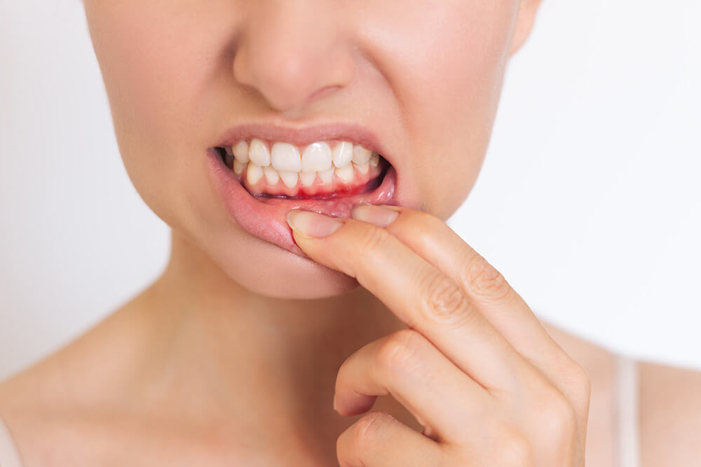 Why do I have swollen gums